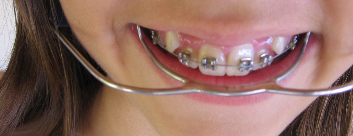 Szybkie leczenie zębów Legnica