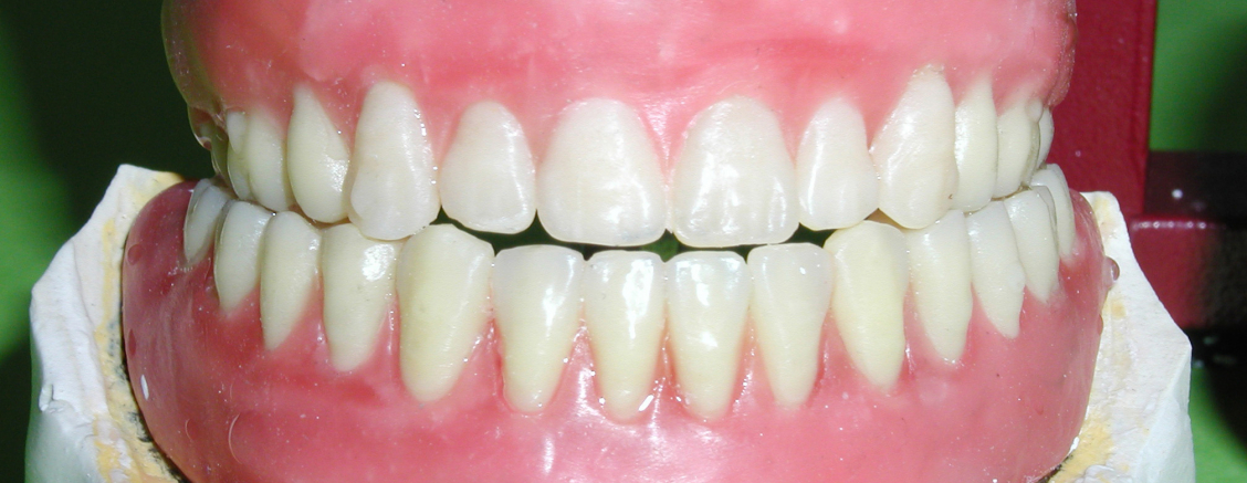 Professional and inexpensive all – ceramic crowns, London